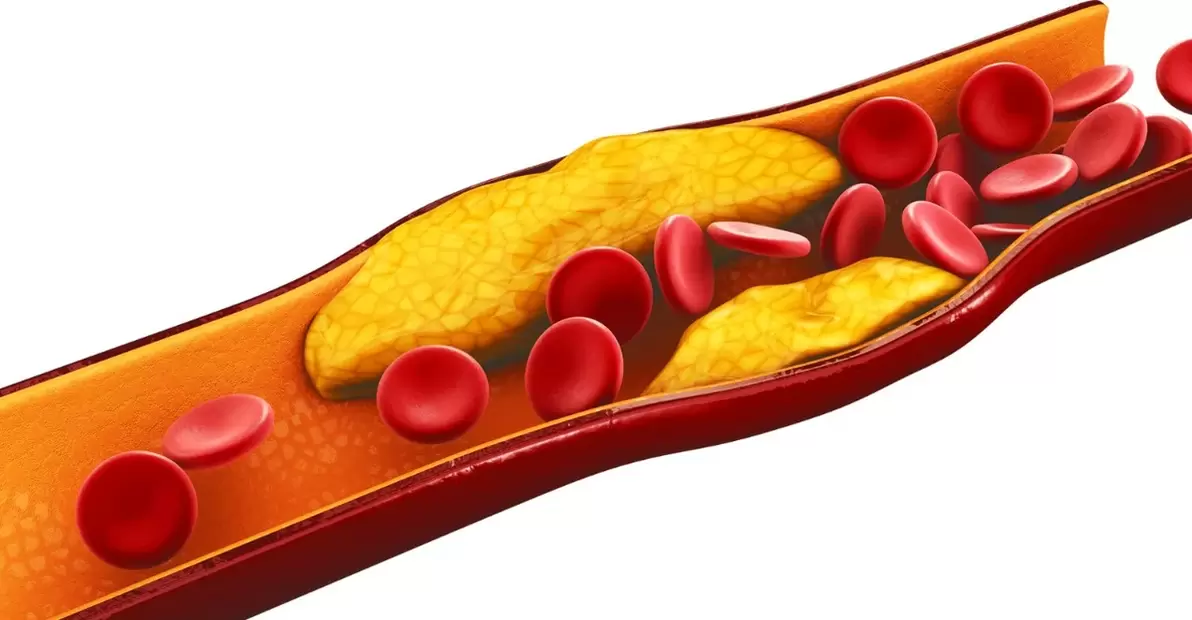 o motivo para tomar cápsulas MiCardium é a aterosclerose vascular